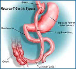 Gastric Bypass diagram